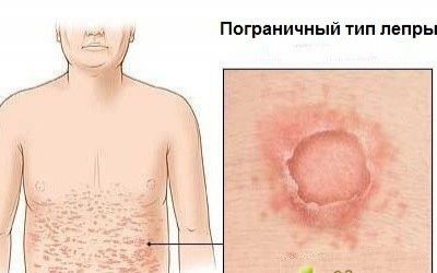 100 человек в Азербайджане страдают от лепры