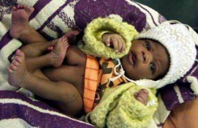 В Африке опять родился младенец с лишними ногами