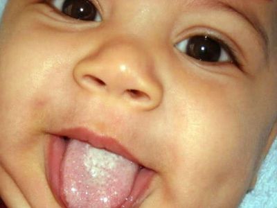 Körpələrin ağız boşluğunda yaranan göbələk və onunla mübarizə Körpələrin ağız boşluğunda yaranan göbələk və onunla mübarizə