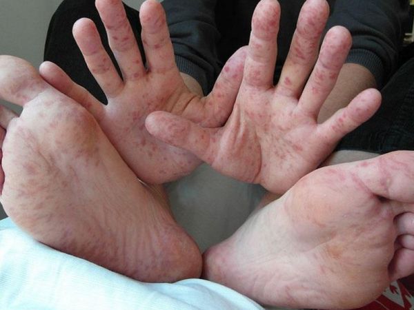 Bakıda uşaqlar arasında "Koksaki" virusuna yoluxma halları artıb - PEDİATR Bakıda uşaqlar arasında "Koksaki" virusuna yoluxma halları artıb - PEDİATR