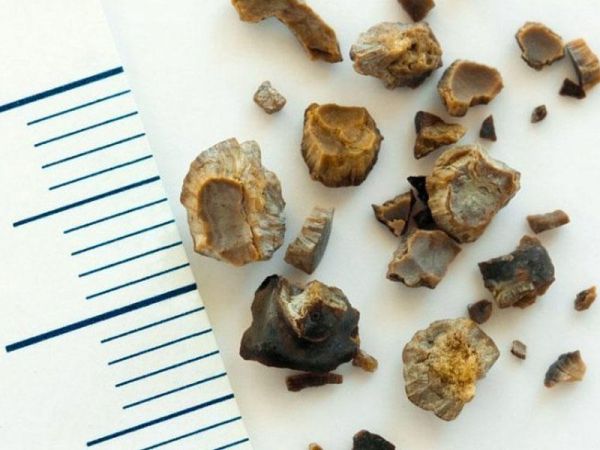 Böyrəklərdə daş niyə yaranır? - 5 əsas amil Böyrəklərdə daş niyə yaranır? - 5 əsas amil