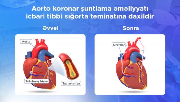 Aorto-koronar şuntlama əməliyyatı icbari tibbi sığorta ilə qarşılanır