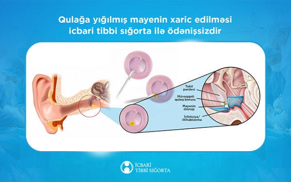 İcbari tibbi sığorta bu əməliyyatı da qarşılayır İcbari tibbi sığorta bu əməliyyatı da qarşılayır