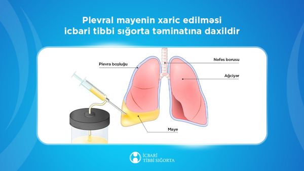 Ağciyərlərə yığılmış mayenin çəkilməsi məqsədilə - 5643 prosedur icra olunub